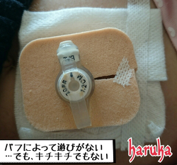 我が家の胃瘻の処置いろいろ 漏れ対策 肉芽への対応 13トリソミー ケアチャネル